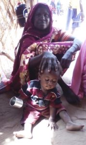 malnutrition sévère au Soudan du Sud